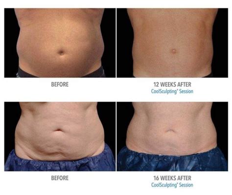 coolsculpting chula vista|100 CoolSculpting doctors & clinics in Chula Vista, CA.